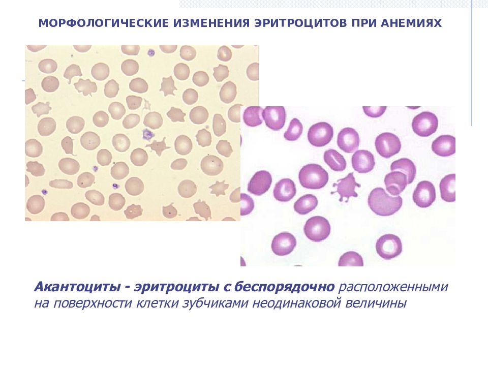 Измененные клетки. Изменение эритроцитов при и12 анемии. В12 дефицитная анемия морфология эритроцитов. Морфология эритроцитов при в12 дефицитной анемии. Изменение формы эритроцитов при анемии.