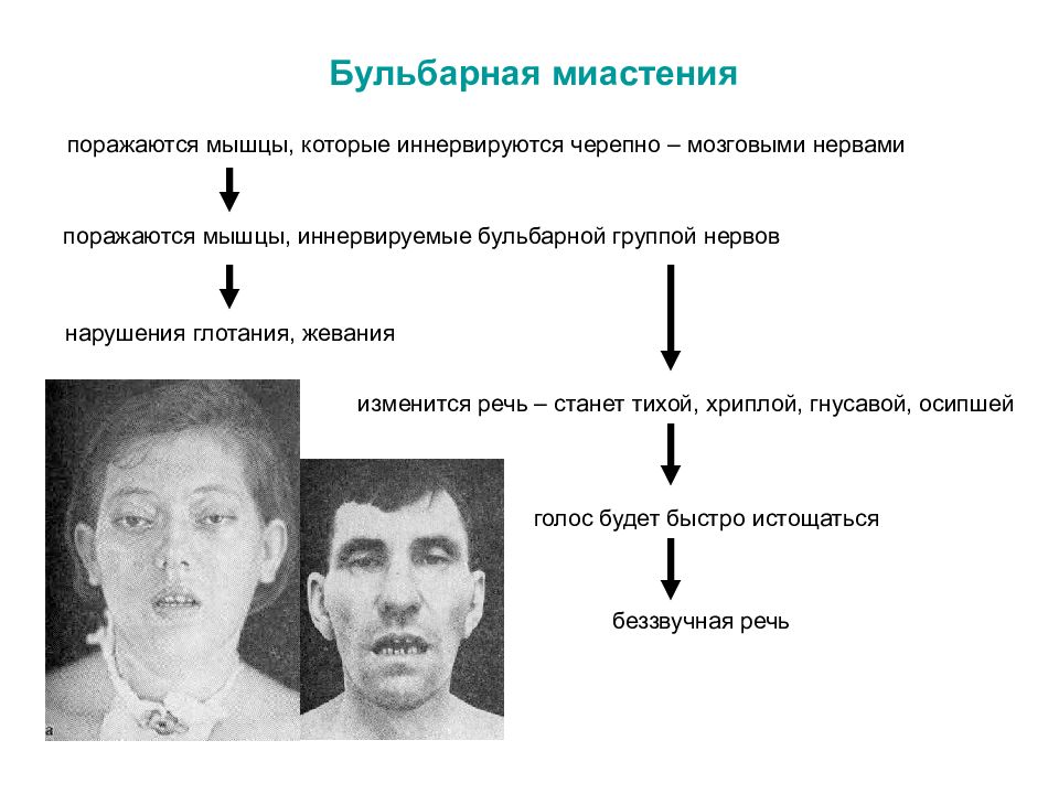 В формировании клинической картины синдрома авеллиса участвует черепной нерв