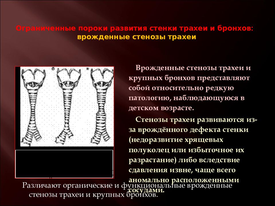 Пороки Развития Трахеи