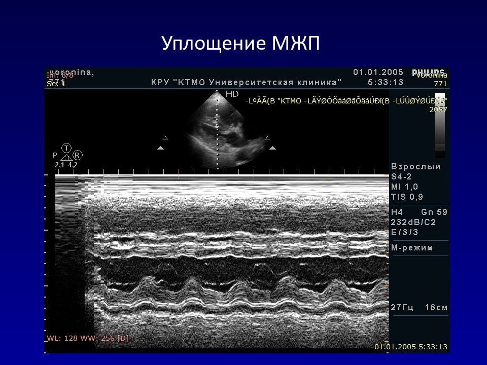 М режим. Парадоксальное движение межжелудочковой перегородки. Парадоксальное движение МЖП. Парадоксальное движение межжелудочковой перегородки причины. Парадоксальное движение МЖП на ЭХОКГ.