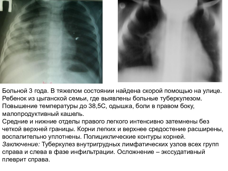 Лимфаденопатия корня. Лимфаденопатия на рентгене легких. Лимфаденопатия внутригрудных узлов. Лимфаденопатия рентген.