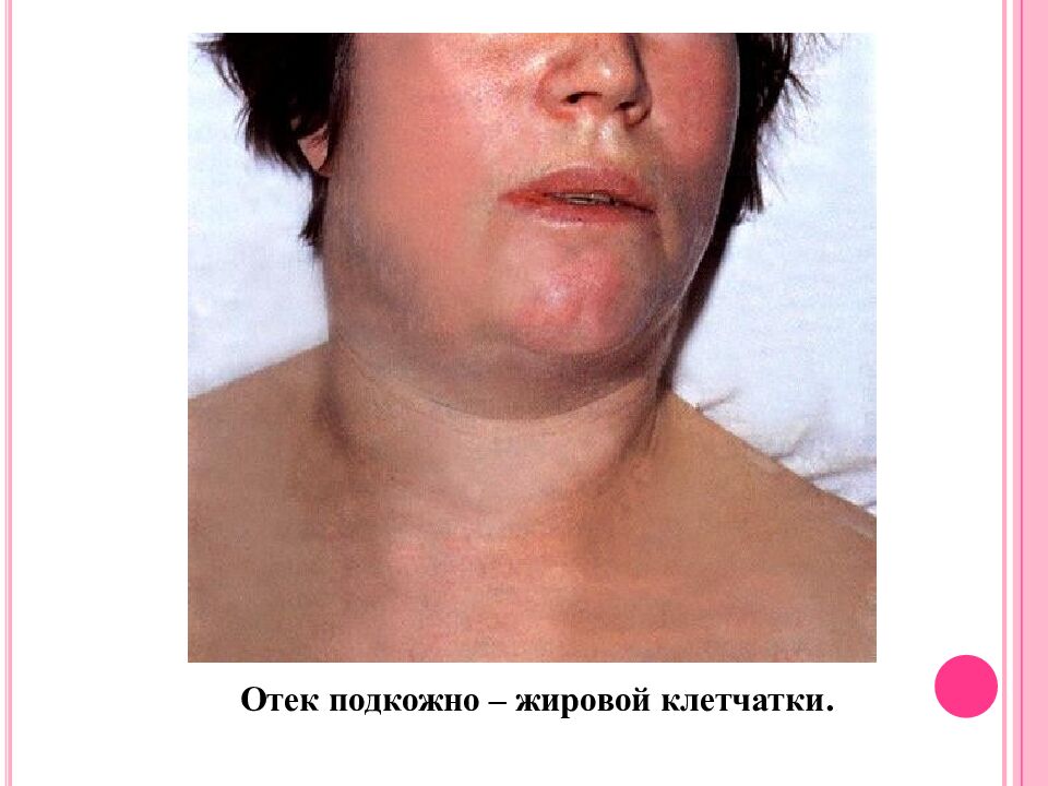 Токсическая форма дифтерии