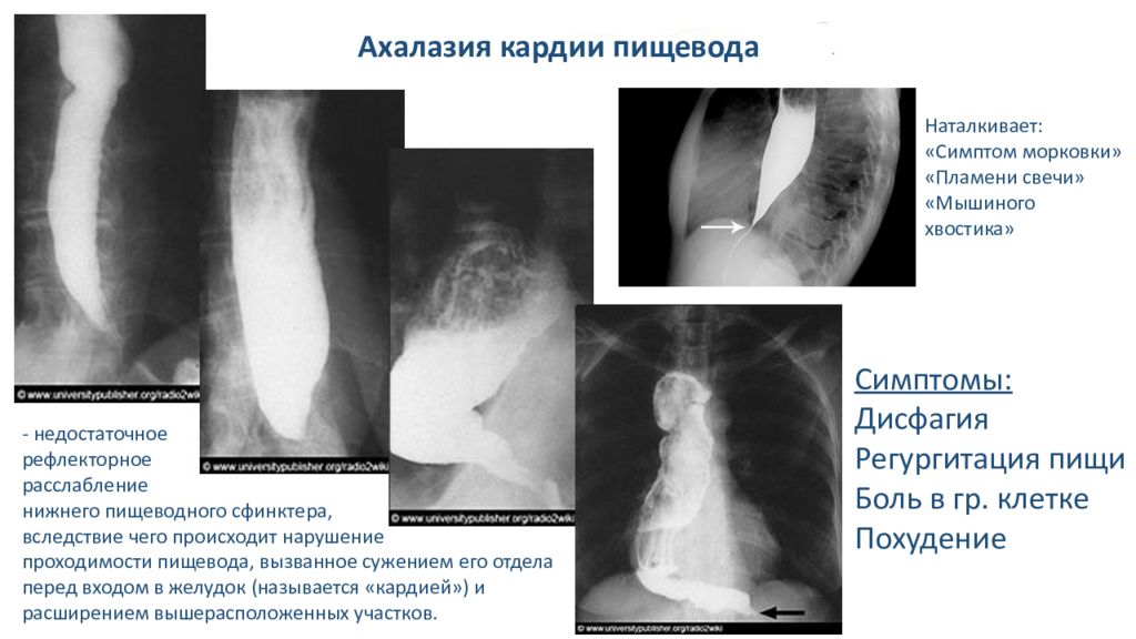 Недостаточность кардии желудка симптомы