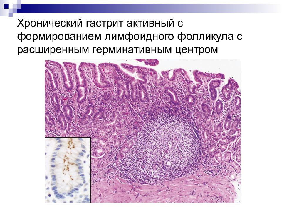 Лимфоидные фолликулы