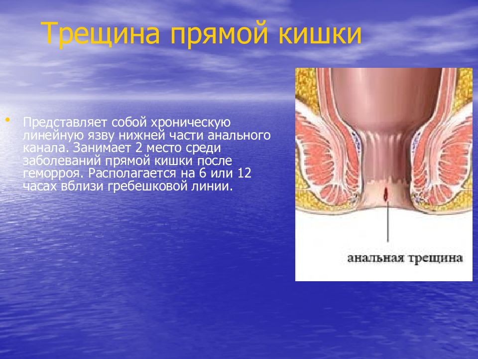 Трещины заднего прохода презентация