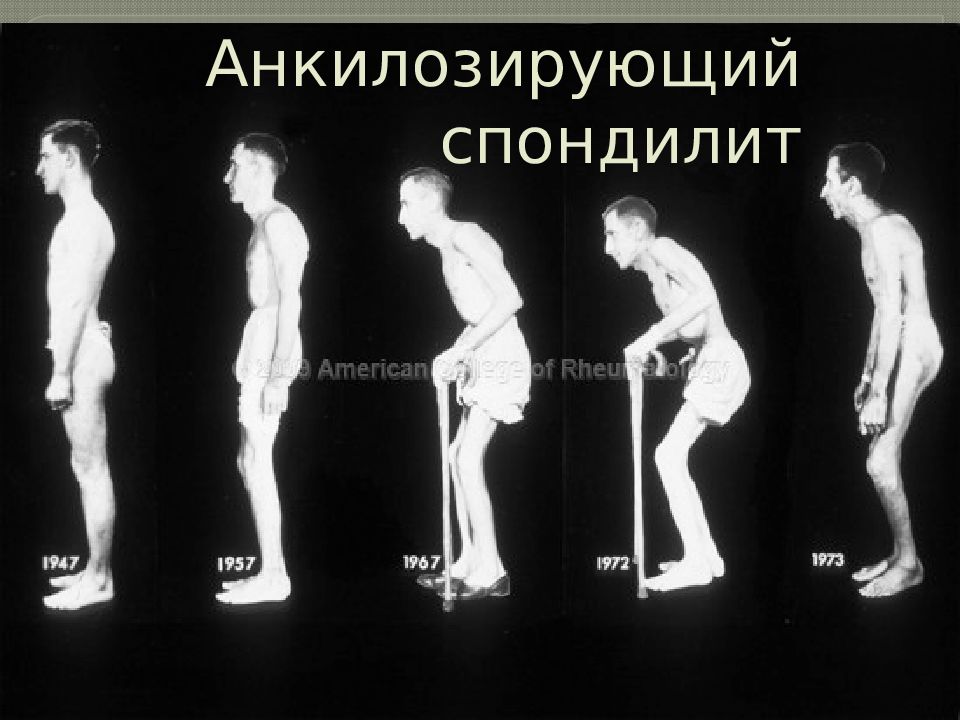 Анкилозирующий спондилит