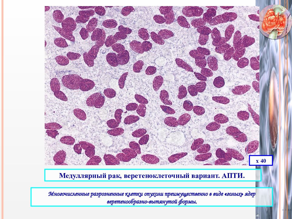 Медуллярный рак рекомендации. Медуллярная карцинома щитовидной железы. Карцинома щитовидной железы гистология. Медуллярная карцинома щитовидной железы гистология. Недифференцированная (анапластическая) карцинома..