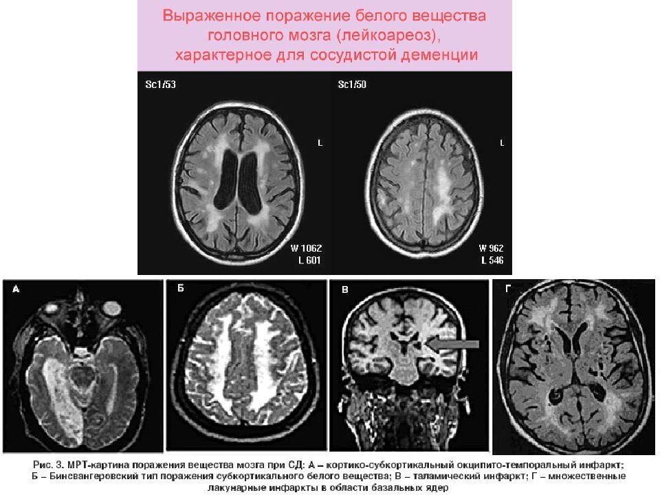 Презентация сосудистая деменция