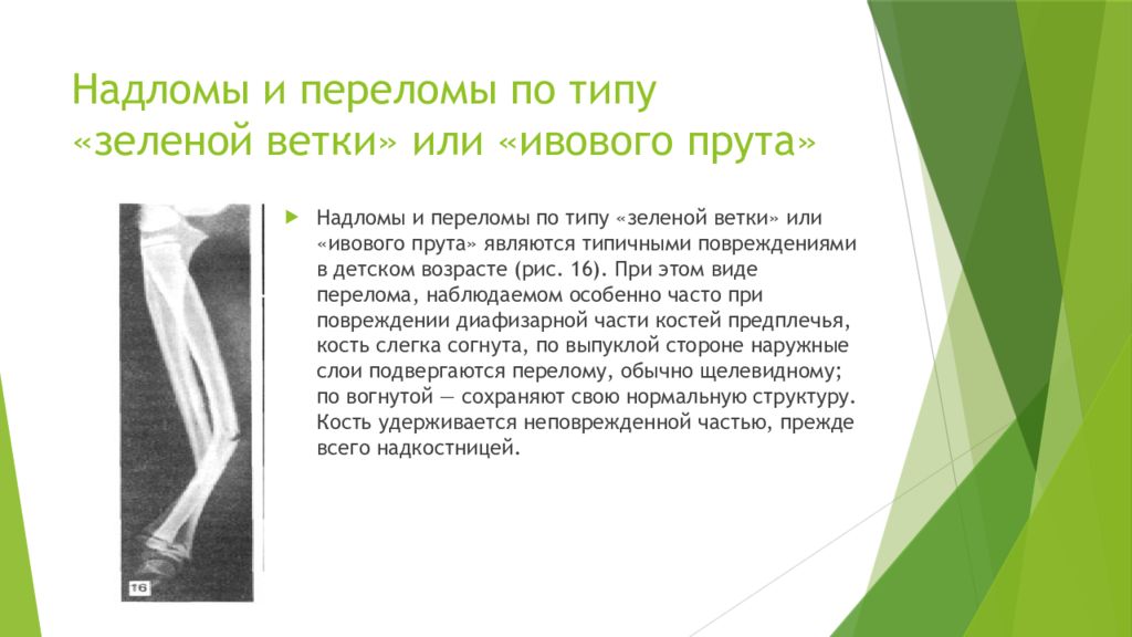 Перелом костей у детей. Поднадкостничный перелом по типу зеленой веточки. Перелом по типу зеленой веточки у детей. Перелом лучевой кости по типу зеленой веточки у детей. Переломы кости у детей по типу «зеленой веточки» это-.