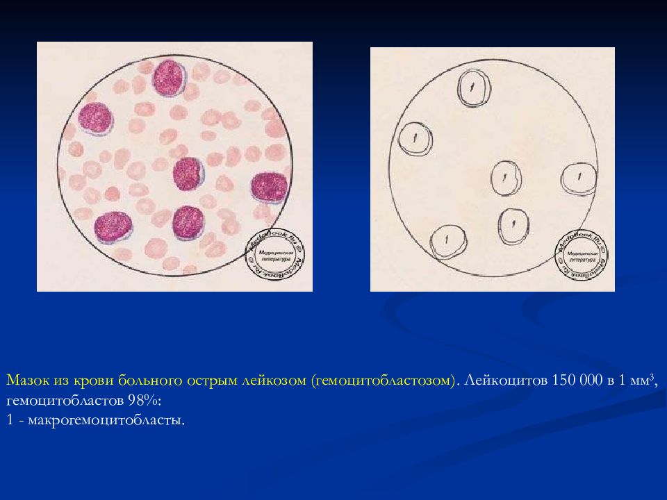 Лейкоз кровотечение. Острый лимфобластный лейкоз мазок. Острый лимфолейкоз мазок крови. Острый лимфобластный лейкоз мазок крови. Хронический миелобластный лейкоз мазок крови.