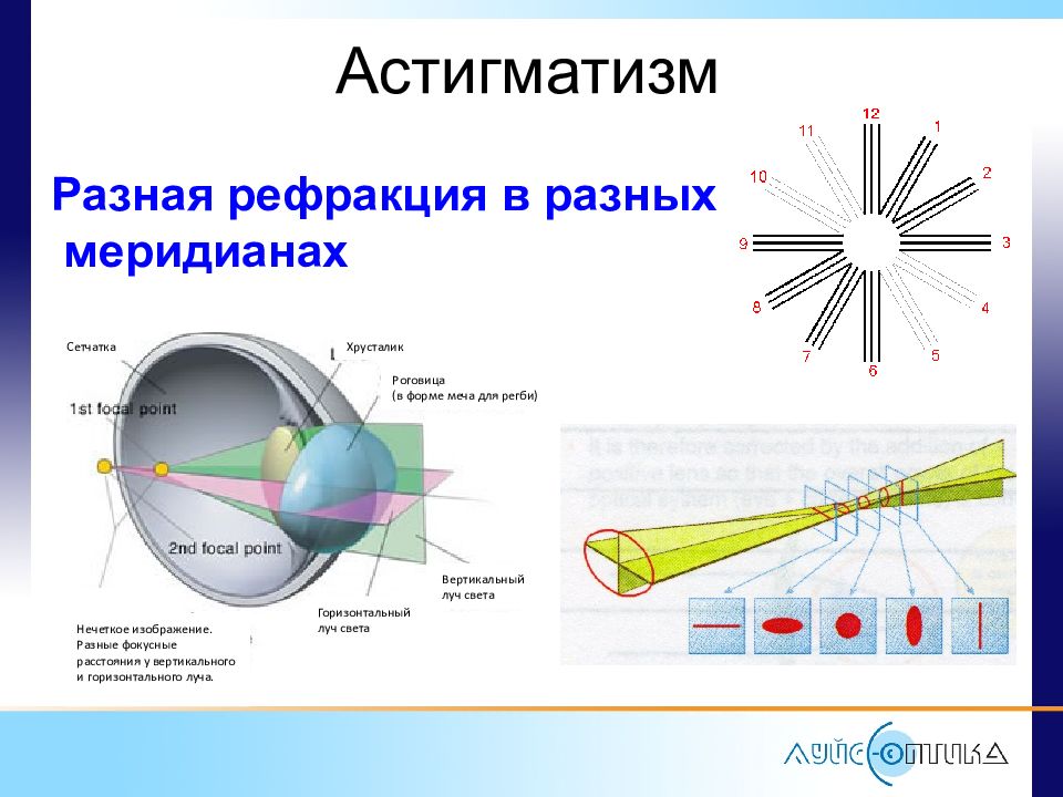 Рефракция в двух главных меридианах. Астигматизм это нарушение рефракции. Рефракция глаза астигматизм. Астигматизм более 6 диоптрий. Разница рефракции астигматизм.