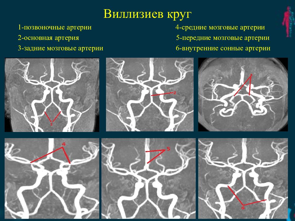 Гипоплазия правой артерии мозга. Круг Захарченко и Виллизиев круг. Виллизиев круг артерии. Виллизиев круг в головном мозге. Незаконченный Виллизиев круг.