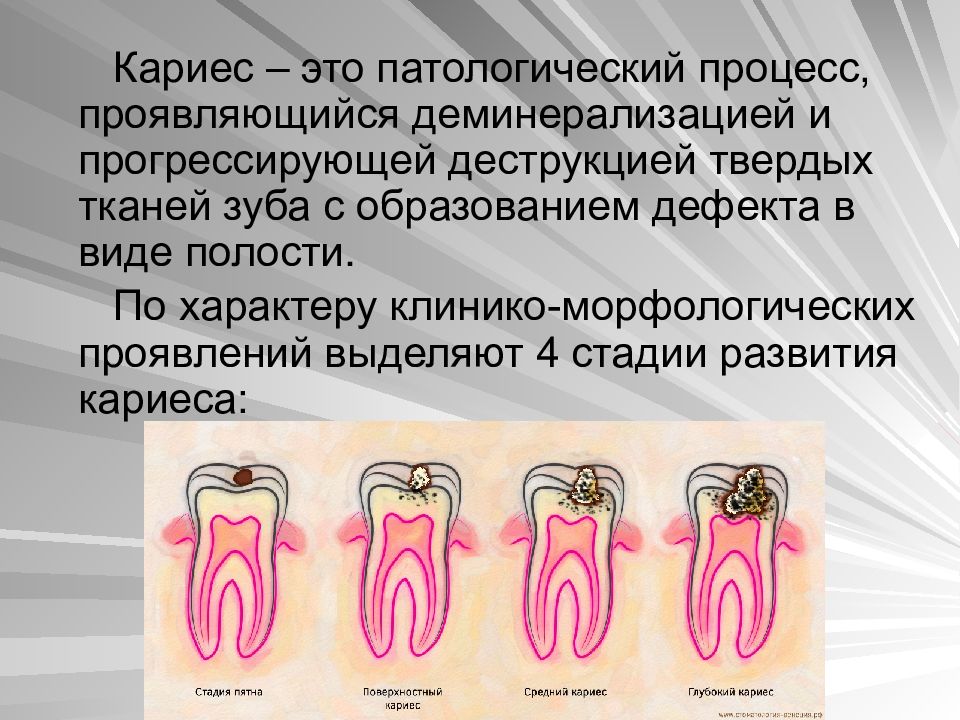 Кариес презентация по стоматологии