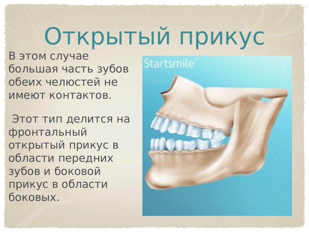 Мезиальный прикус презентация