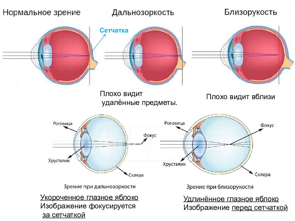 В какой части глазного яблока происходит фокусировка изображения у людей страдающих близорукостью