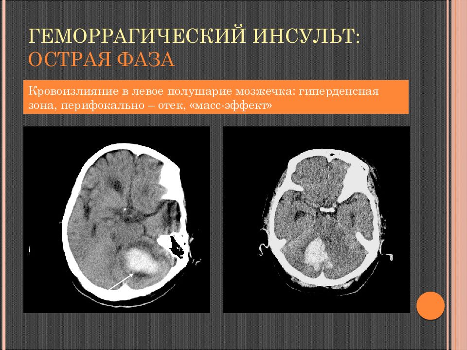 Левое полушарие мозга инсульт. Ишемический инсульт мозжечка кт. Геморрагический инсульт в мозжечке мрт. Ишемический инсульт мозжечка головного мозга кт. Ишемический инсульт с кровоизлиянием на кт.