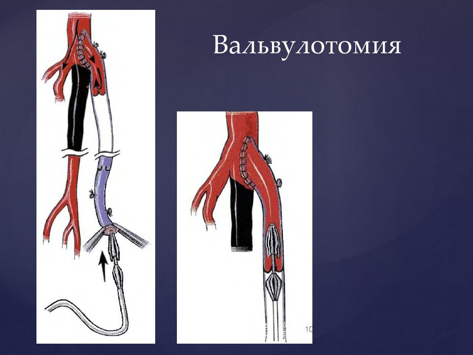 Операция на артерии нижних конечностей. Реваскуляризация артерий нижних конечностей. Шунтирование подвздошной артерии. Протезирование подвздошной артерии. Реваскуляризация конечности.