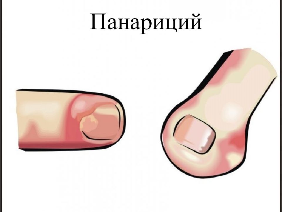 Панариций