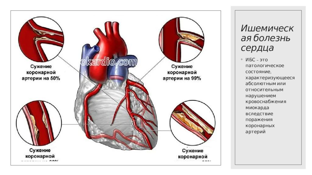 Коронарная ишемия. Ишемическая болезнь сердца. Ишемическая болезнь сердца (ИБС). Стеноз коронарных артерий. Нарушение кровоснабжения миокарда.