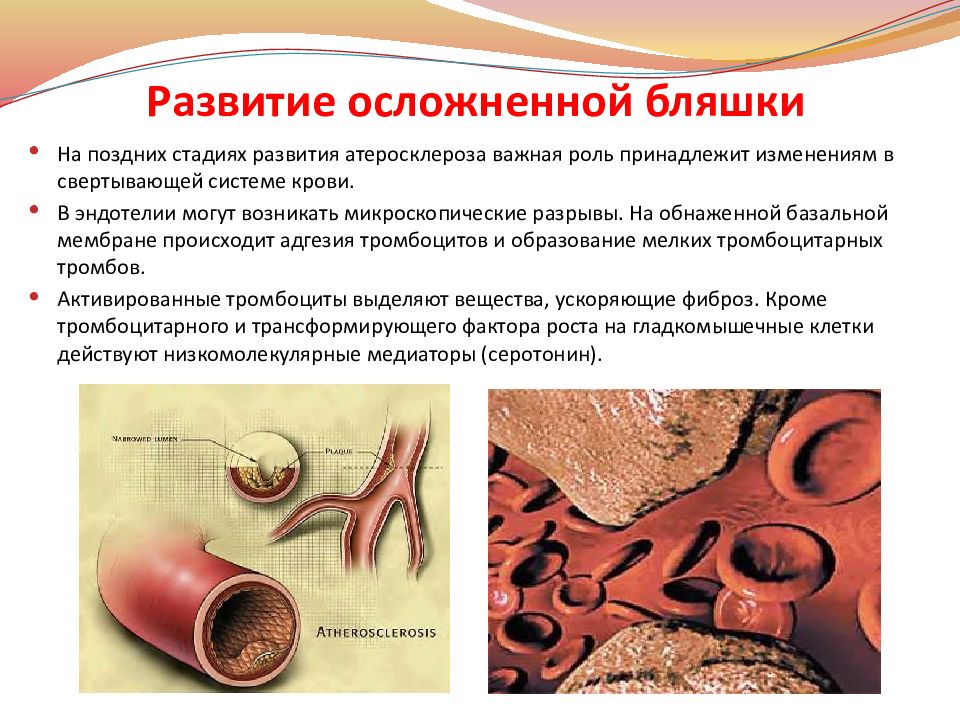 Атеросклероз — презентация
