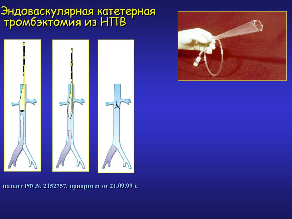 Эндоваскулярный хирург. Катетерная тромбэктомия. Эндоваскулярная катетерная тромбэктомия. Эндоваскулярная аспирационная тромбэктомия. Катетерная аспирационная тромбэктомия.