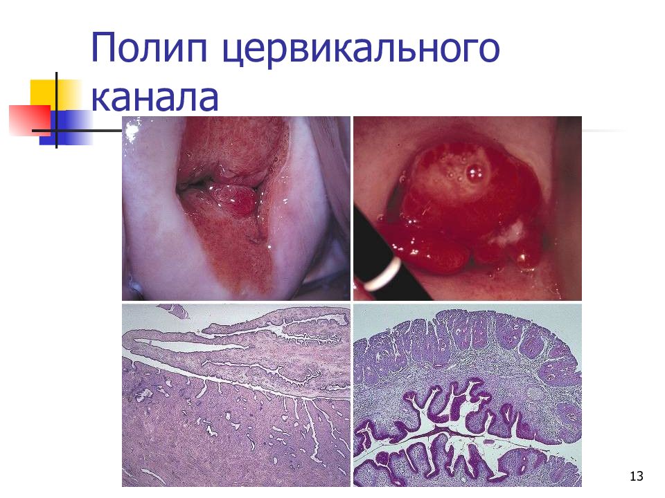 Полип цервикального канала фото