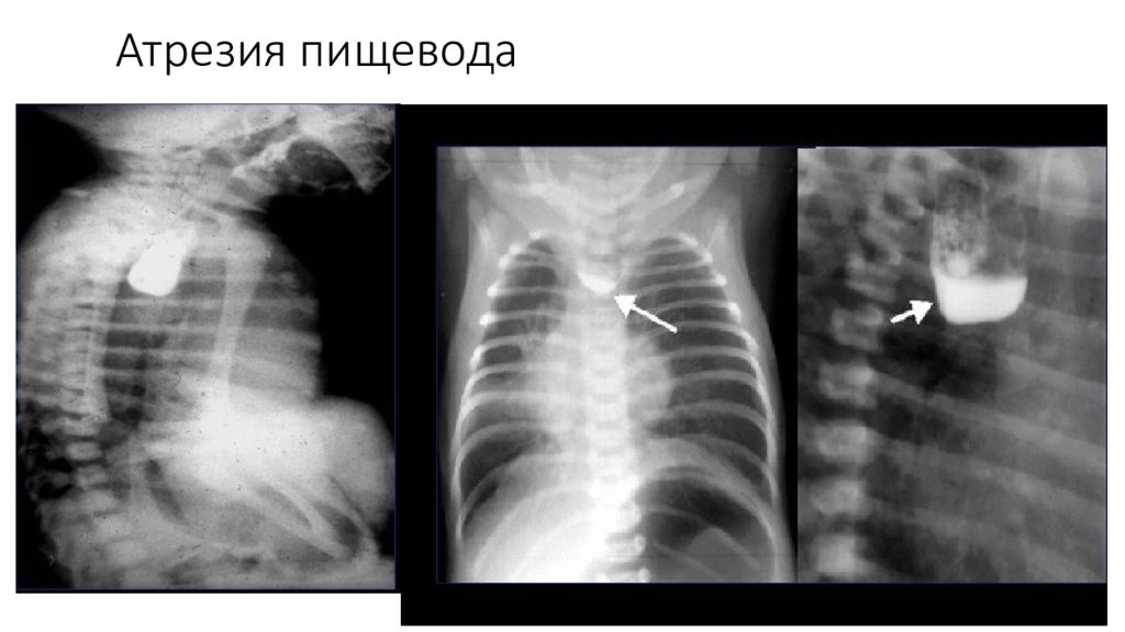 Атрезия это. Безсвищевая форма атрезии пищевода.