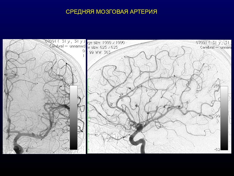 Артерии среднего мозга