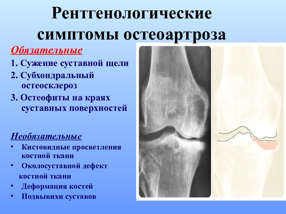 Лечение деформирующего остеоартроза презентация