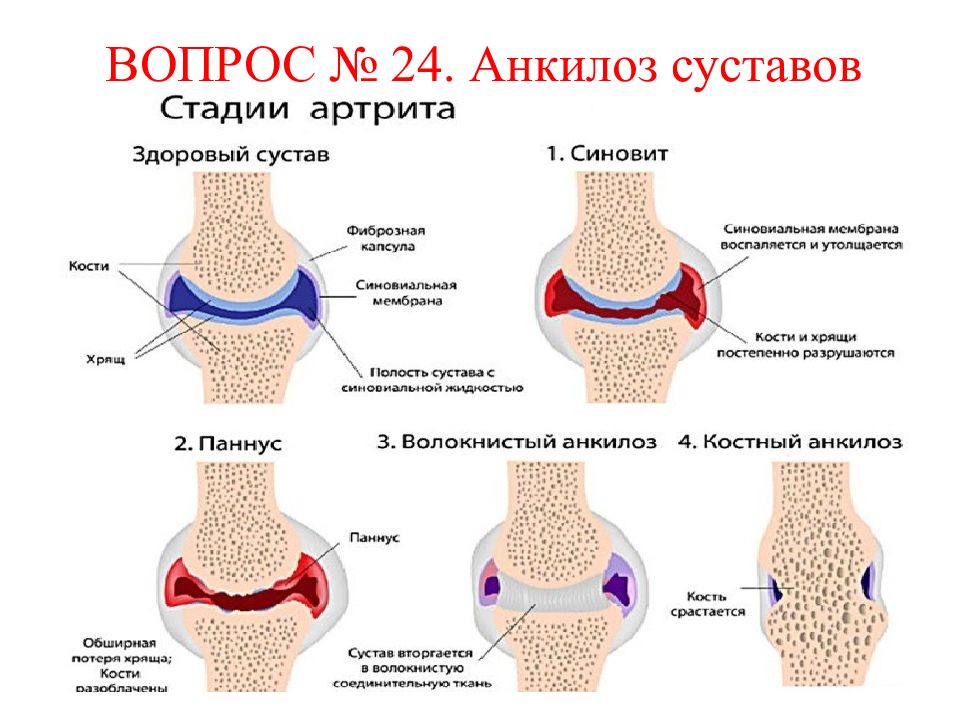 Презентация на тему артроз