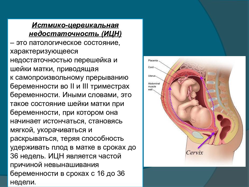 Истмико цервикальная недостаточность презентация