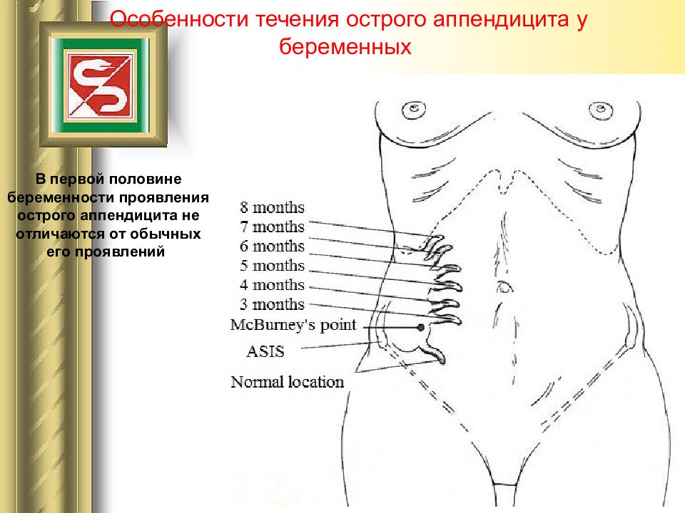 Картинка где болит аппендицит