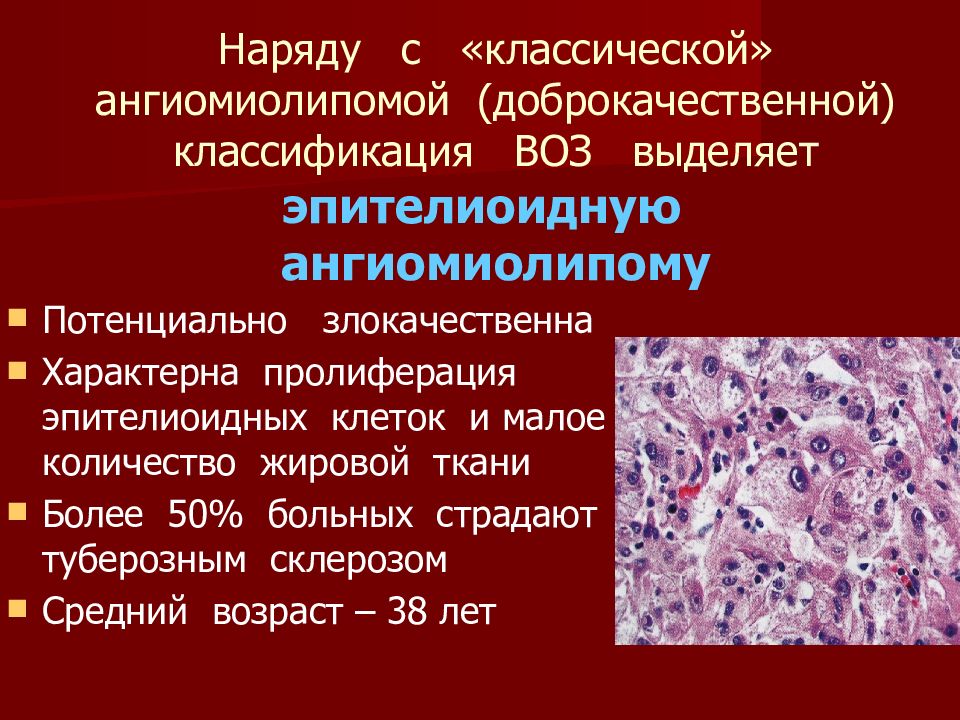 Ангиомиолипома мкб 10. Эпителиоидная ангиомиолипома почки злокачественная. Ангиомиолипомы левой почки. Доброкачественные и злокачественные опухоли. Ангиомиолипома гистология.