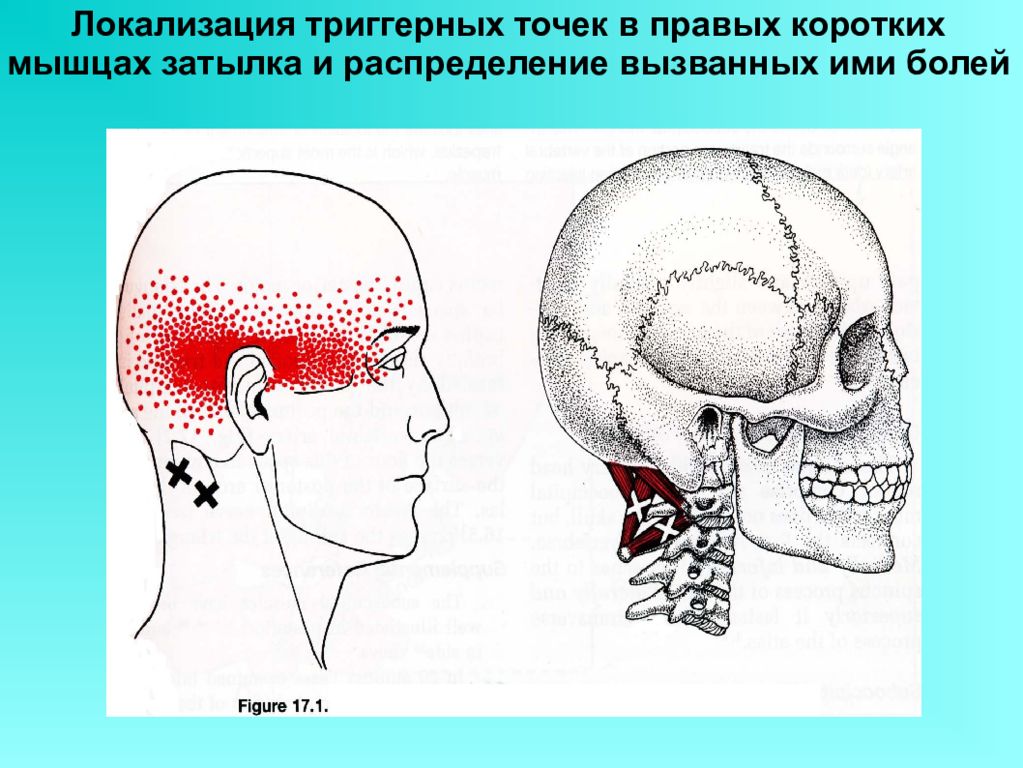 Болит шея у основания головы