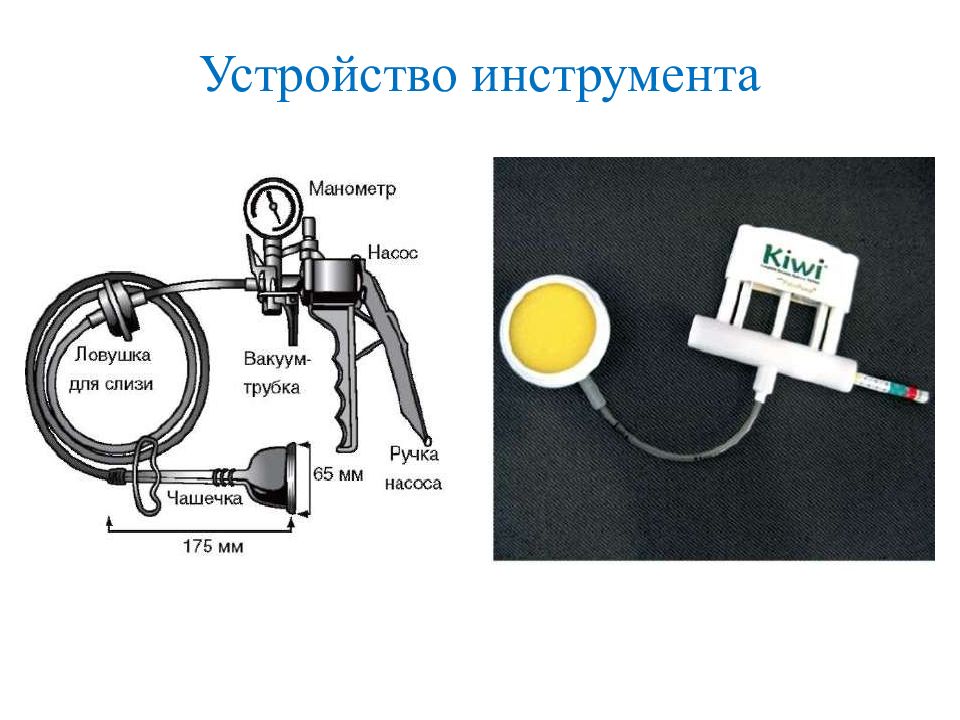 Вакуум экстракция плода презентация