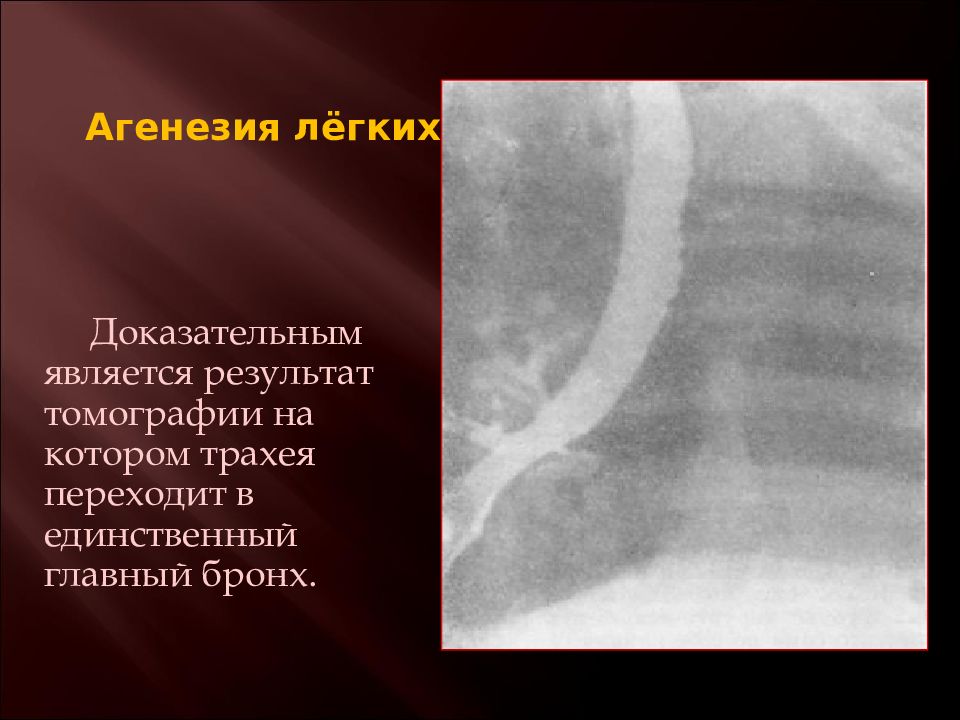 Агенезия это. Врожденные пороки развития легких. Аномалии развития легких. Агенезия легкого у детей.