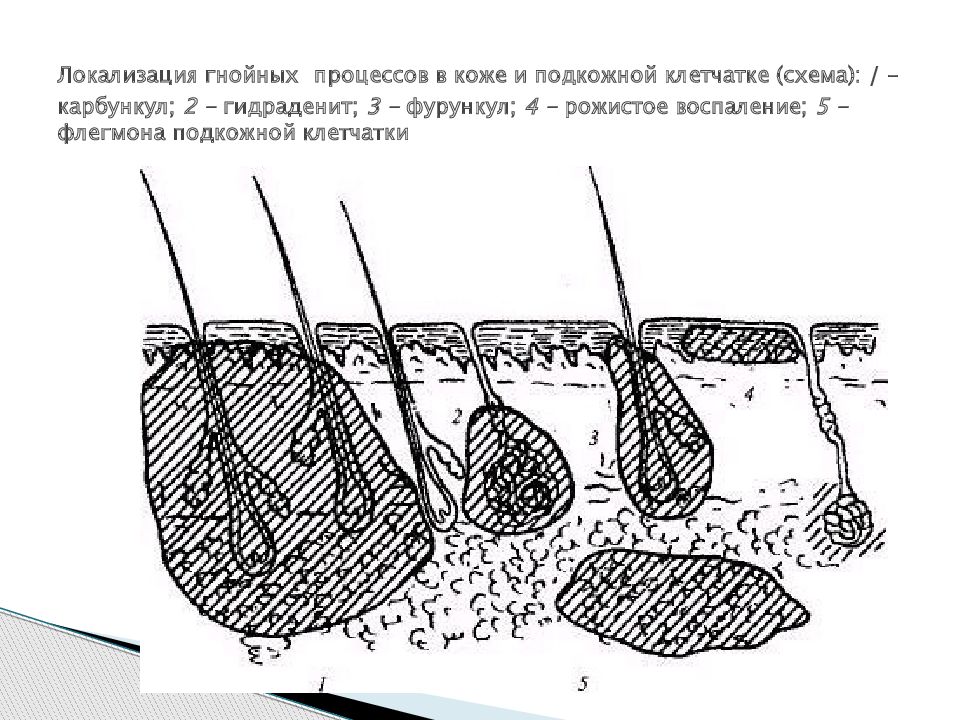 Частая локализация. Фурункул абсцесс флегмона. Локализация гнойных процессов в коже и подкожной клетчатки. Абсцесс флегмона гидраденит. Фурункул карбункул флегмона.