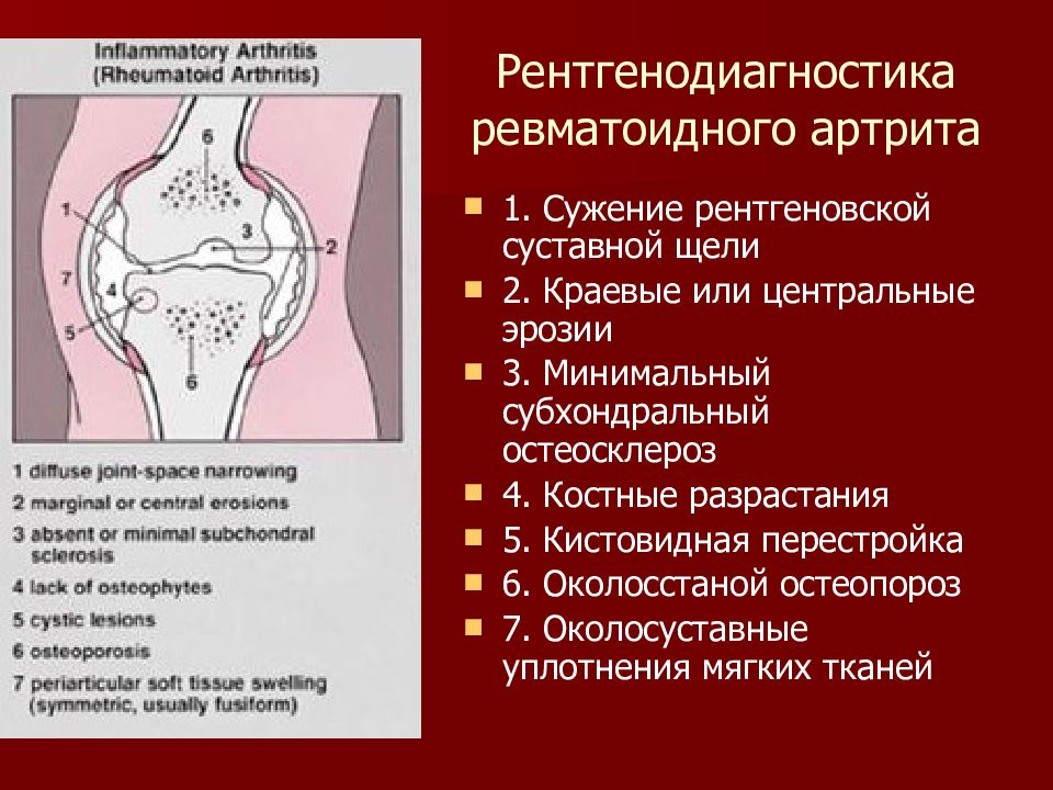 Склероз суставных поверхностей. Субхондральный остеопороз. Субхондральный остеосклероз. Субхондральные отделы тазобедренного сустава. Суставные поверхности уплотнены.