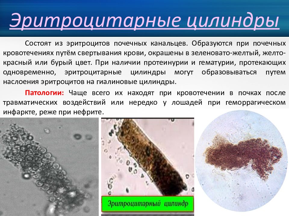 На наличие цилиндров при микроскопии осадка мочи указывает картина