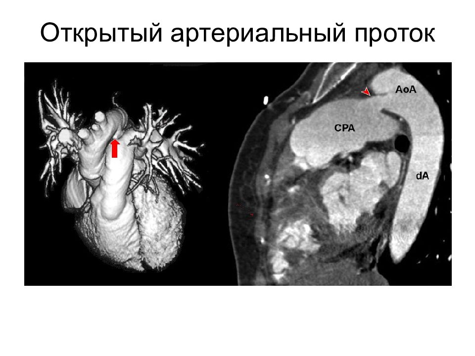 Открытый аортальный проток схема