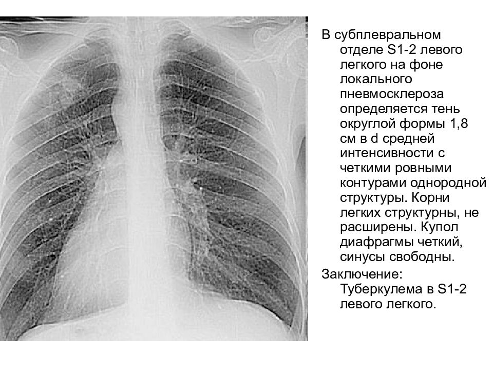 Фиброзная деформация легочного рисунка