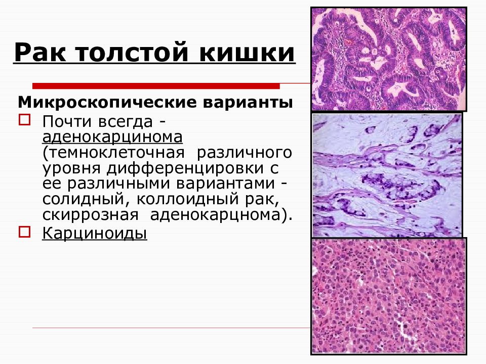 Рак толстой кишки клинические рекомендации