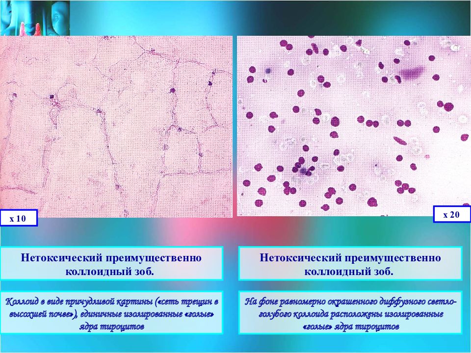 Цитологическая картина коллоидного узла