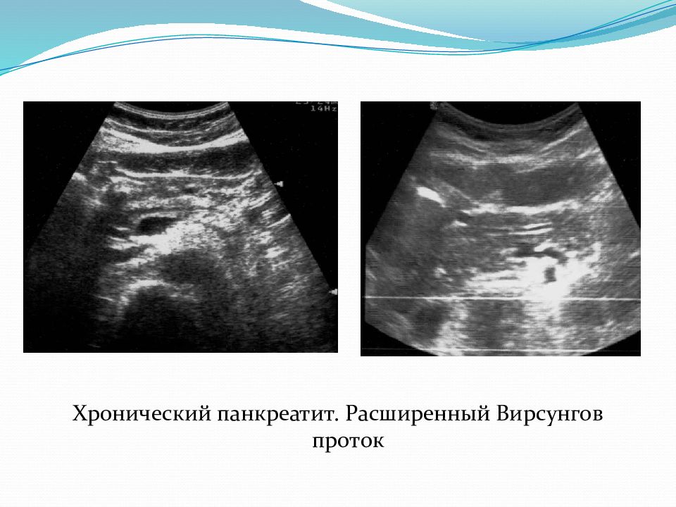 Узи картина хронического панкреатита