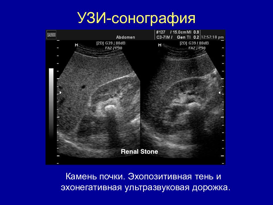 Сонограмма это. Ультразвуковые исследования(сонография ) почек. УЗИ почек сонограмма. Сонограмма почки. УЗИ сонография.