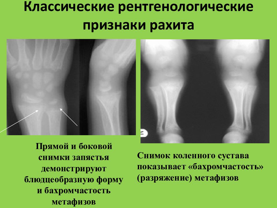 Рахит спазмофилия гипервитаминоз д у детей презентация