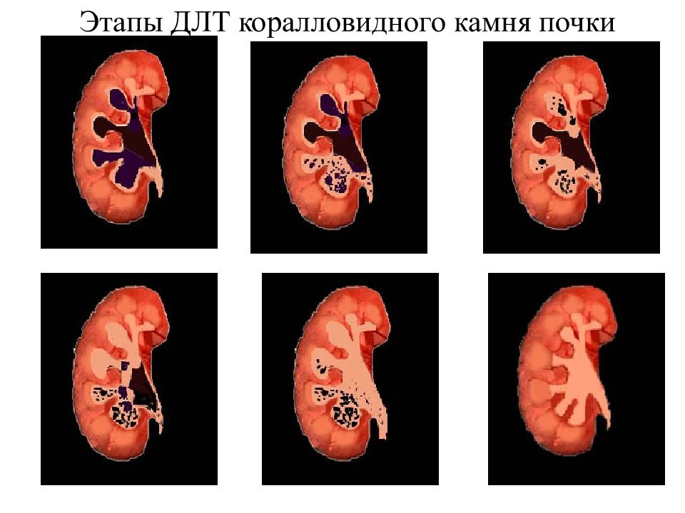 Размеры конкрементов почек. Мочекаменная болезнь коралловидные камни. Коралловидный нефролитиаз. Коралловидный камень в почке. Коралловидный нефролитиаз 1.