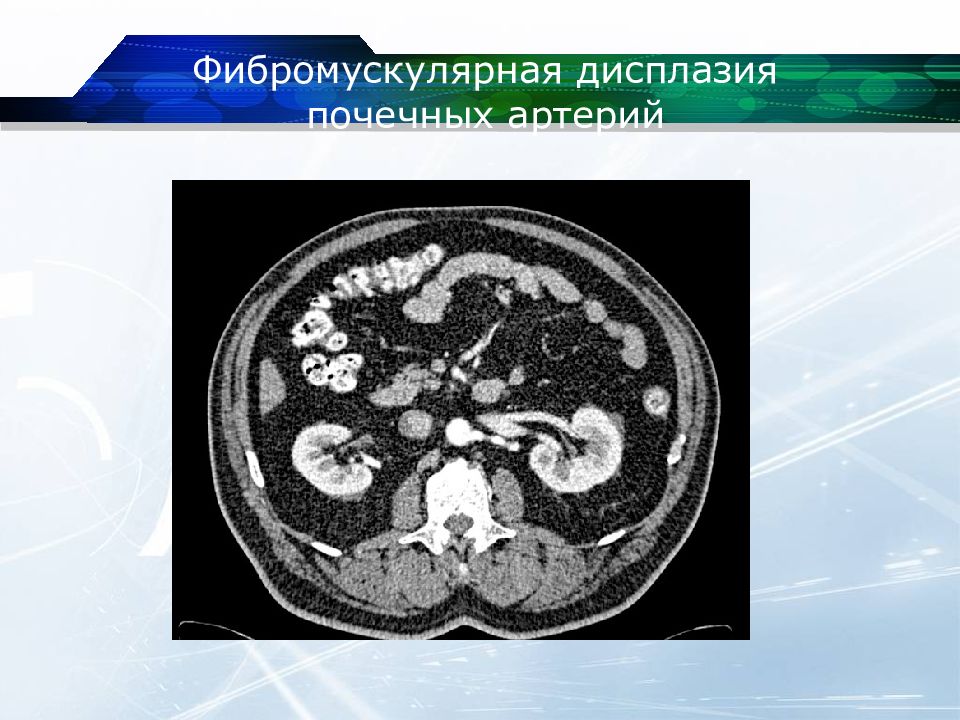 Дисплазия почки презентация