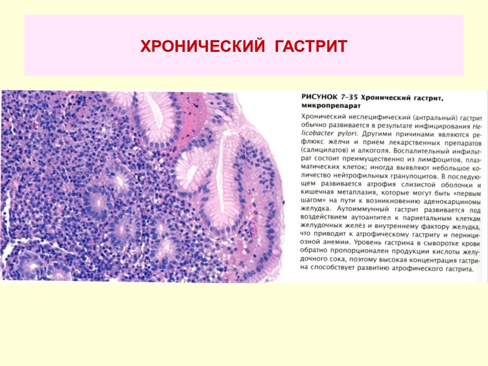 Гистологические признаки хронического гастрита. Хронический хеликобактерный гастрит микропрепарат. Патанатомия хронический атрофический гастрит микропрепараты. Гиперплазия желудка гистология.