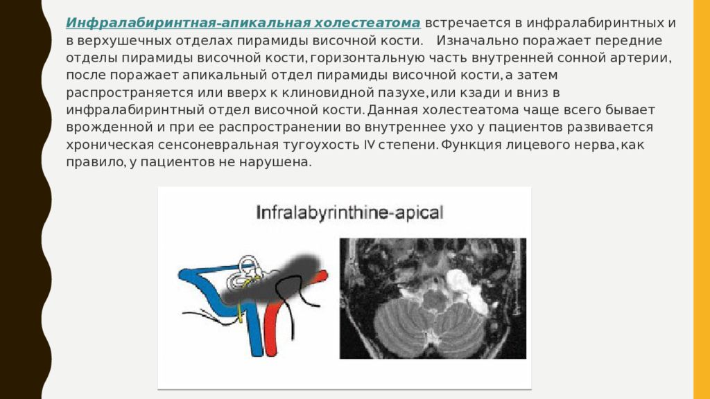 Холеастома. Холестеатома пирамиды височной кости. Врожденная холестеатома височной кости. Апикальный отдел.